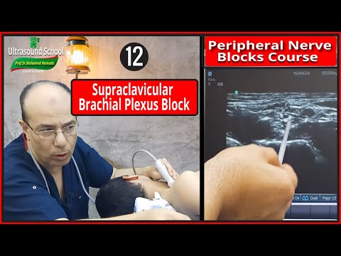 Supraclavicular Plexus Block Ultrasound Guided Peripheral Nerve Blocks Course Mohamed Hamada 12