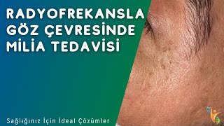 Göz Çevresinde Ameliyatsız Milia Tedavisi Nasıl Yapılır? - Idea Klinik