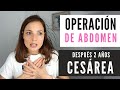 Operación en Abdomen tras una Cesárea 😯 ¿Por qué me operaron? ¿Es común tras una cesárea?