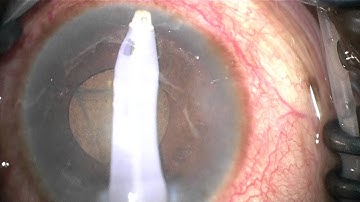 AC washout 1 mo p phaco-trabectome, inferior fluffy particle (was panuveitis not lens particle)