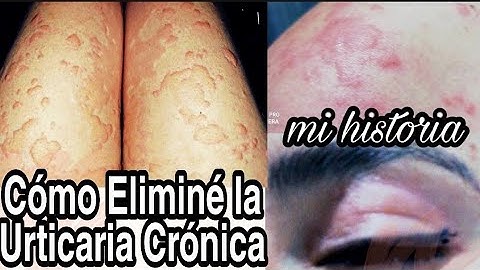 Urticaria Crónica, mi Historia y como me deshice de ella?