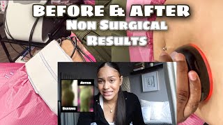 I GOT MY BODY DONE (NON SURGICAL!!)| IS IT WORTH IT?...| Lipo Cavitation & Butt Vacuum Therapy