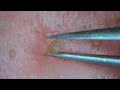 0284 keratin plug removal nose