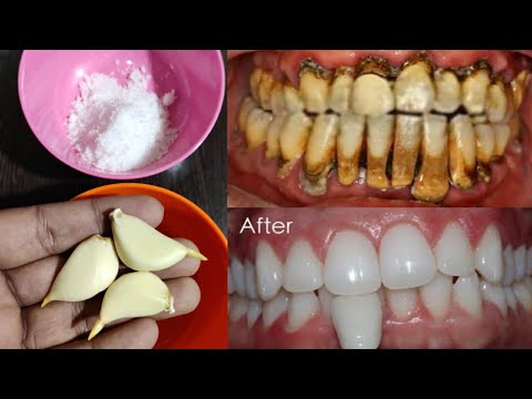 गंदे पीले दांतों को 5 मिनट में दूध जैसा सफेद और चमकदार बना देगा ये तरीका | teeth whitening remedy