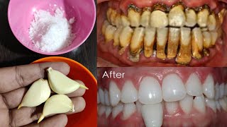 गंदे पीले दांतों को 5 मिनट में दूध जैसा सफेद और चमकदार बना देगा ये तरीका | teeth whitening remedy