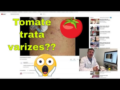 Varizes: Ozonioterapia, acupuntura, tomates e espuma para tratar veia.