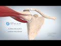 SHOULDER STABLISATION  BY CORACOID BLOCK  (LATARJET PROCEDURE) - DR MATTHIEU MEYER  - PARIS, FRANCE