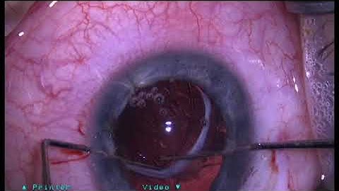 IOL repositioning and fixation with a CTS