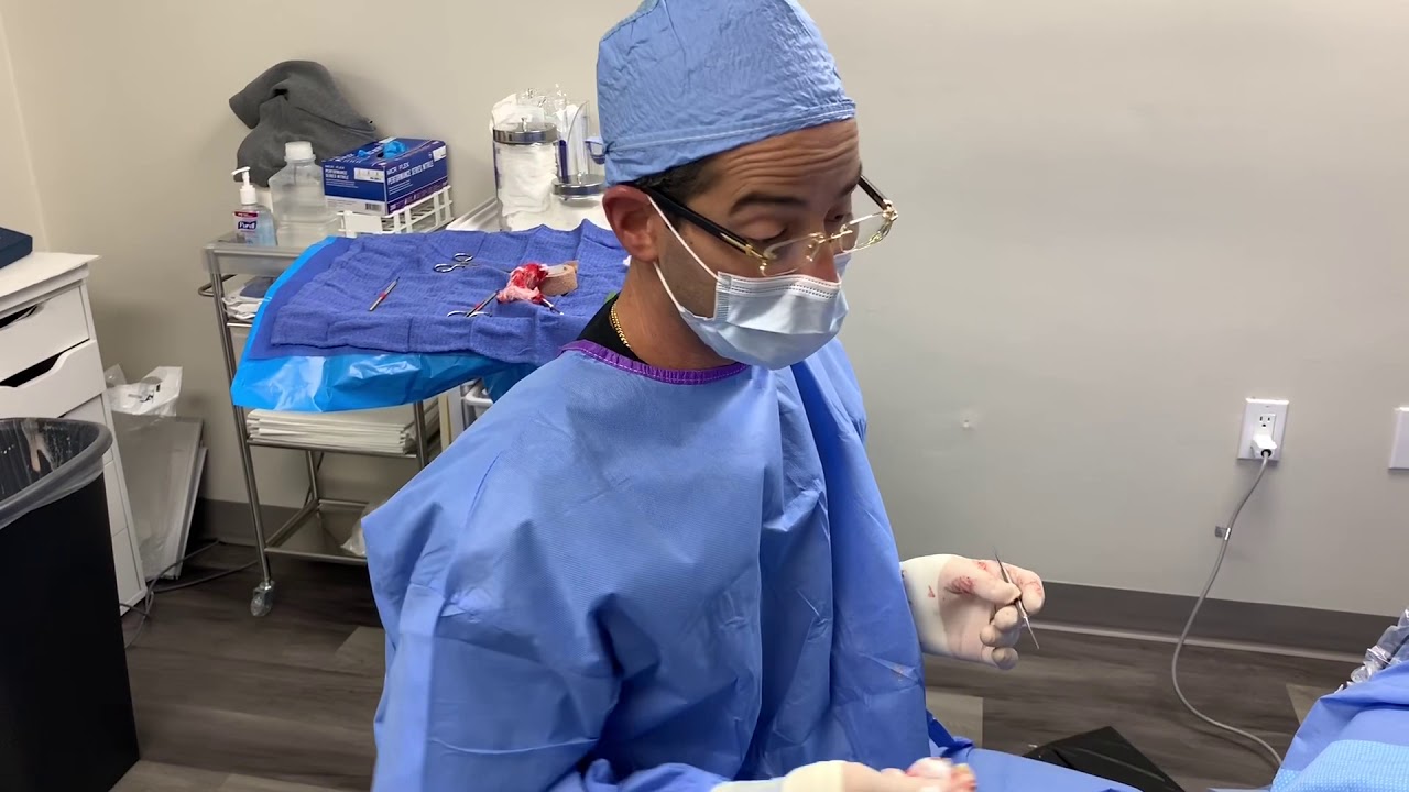 MINIMALLY INVASIVE SURGERY (actual FOOTage) REMOVAL OF BONE SPURS FROM