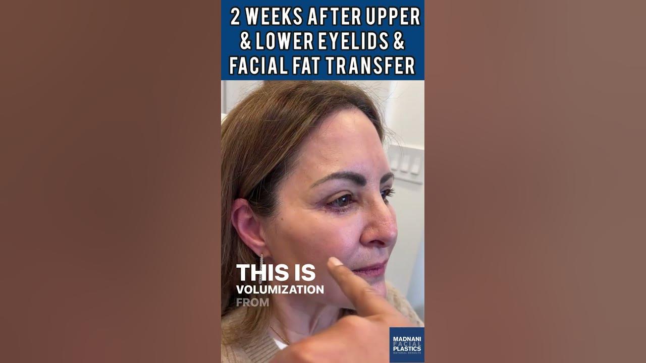 Decca Shots Every 2 Weeks Results 2 Week Results Upper & Lower Eyelid Surgery - YouTube