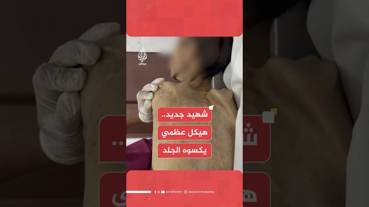 مراسل الجزيرة مباشر: استشهـ.ـ،ـاد الشاب وسام محمود أبو محسن 29 عاما جراء المرض وسوء التغذية