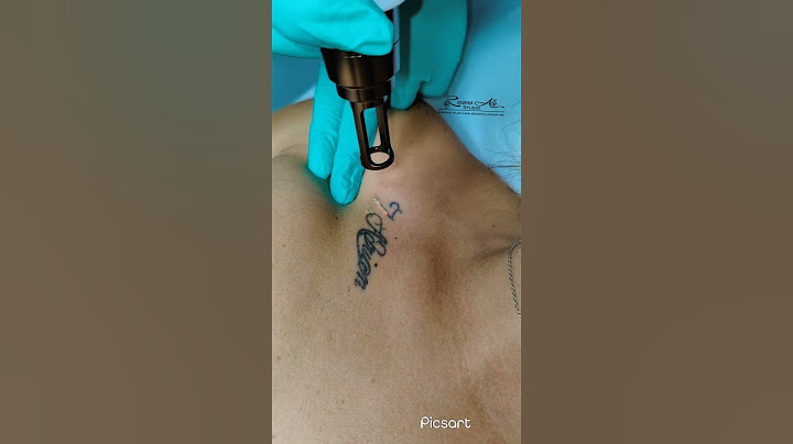 Scoatere Laser Tatuaj Corporal