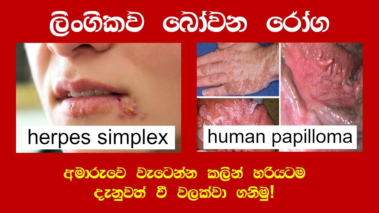 human papillomavirus in sinhala
