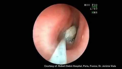 Roth Net Mini foreign body retrieval