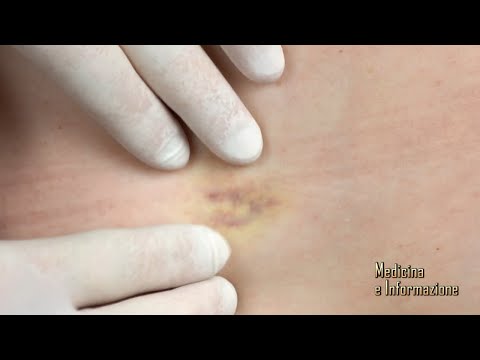 Video: Eruzione Cutanea: 22 Eruzioni Cutanee Comuni, Immagini, Cause E Trattamento