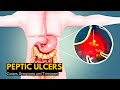 Peptic Ulcers, Causes, Signs and Symptoms, Diagnosis and Treatment.