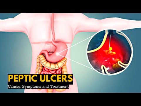 Peptic Ulcers, Causes, Signs and Symptoms, Diagnosis and Treatment.