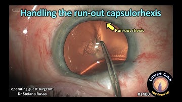 CataractCoach 1400: handling the run-out capsulorhexis
