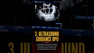 Understanding Egg Retrieval in IVFEgg retrieval (OPU – Ovum Pick-Up) call @ 9187458717