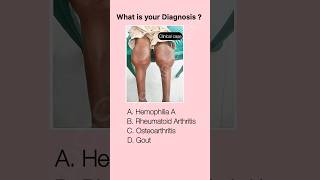 CLinical MCQ #2…💡 #fmge #inicet #tips #mcq #shorts #viral #mbbs