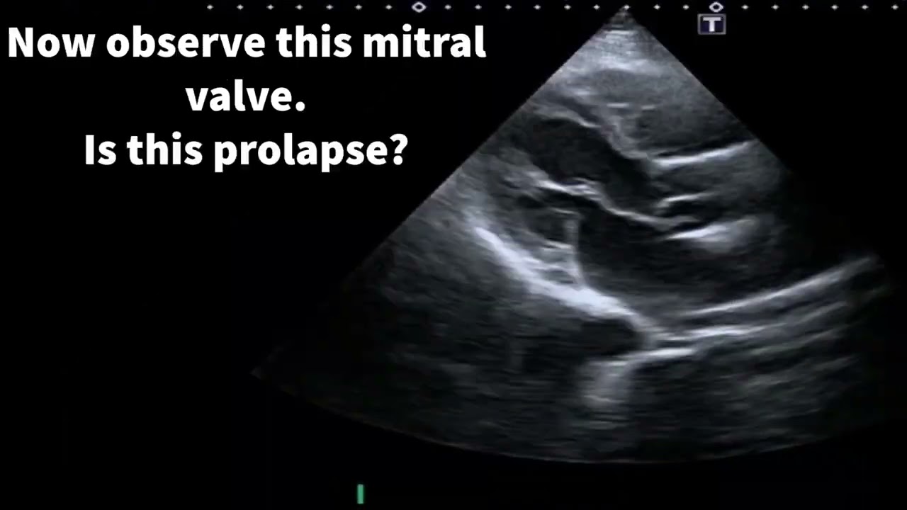Mitral valve prolapse