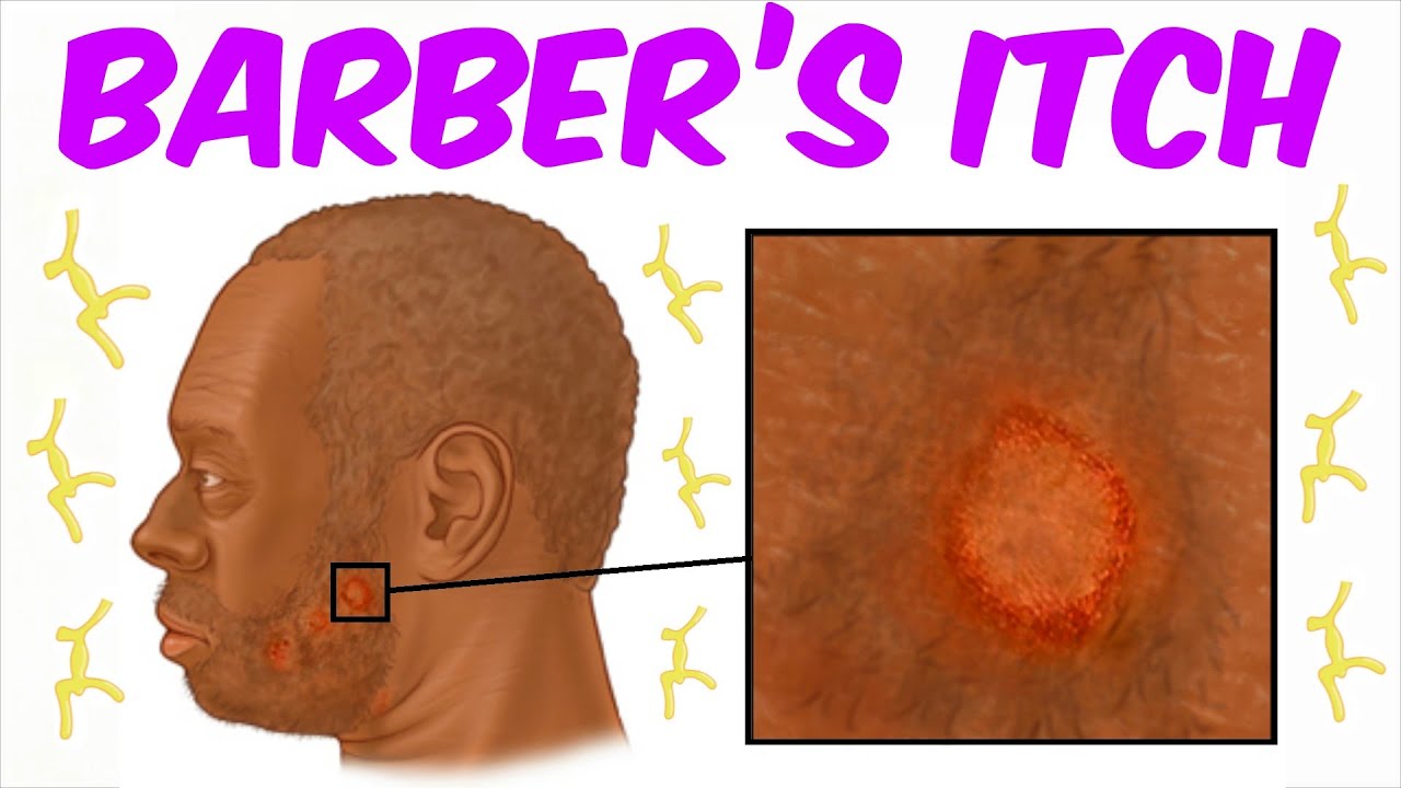 How Do You Know If You Have Tinea Barbae?