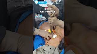 Breast Augmentation Surgery in Delhi | Result After Implant #shortsfeed #shorts