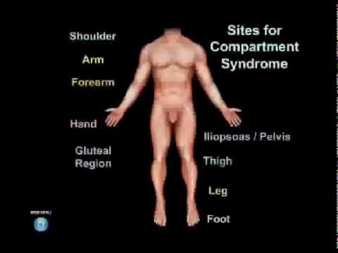 Compartment Syndrome Animation - Everything You Need to Know - Dr. Nabil Ebraheim