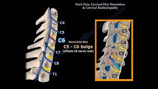 Neck Pain Cervical Disc Herniation and Radiculopathy Causes Symptoms and Treatment