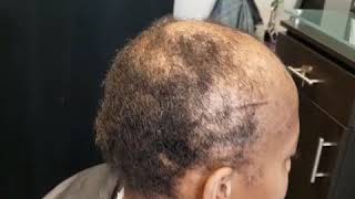 Alopecia Sufferer gets beautiful transformation!