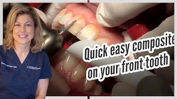 How to fabricate a Full Direct Bonded Restorative