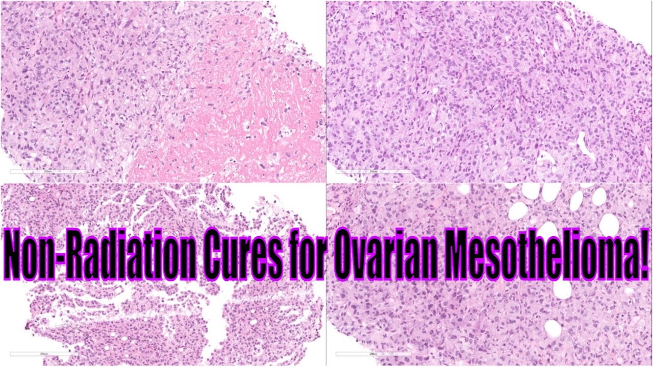 Spectacular Ovarian Mesothelioma Picture for Mobile Spectacular Ovarian Mesothelioma Picture for Mobile