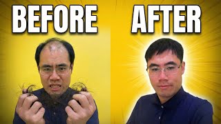 How I Reversed My Hair Loss NATURALLY (Before & After)