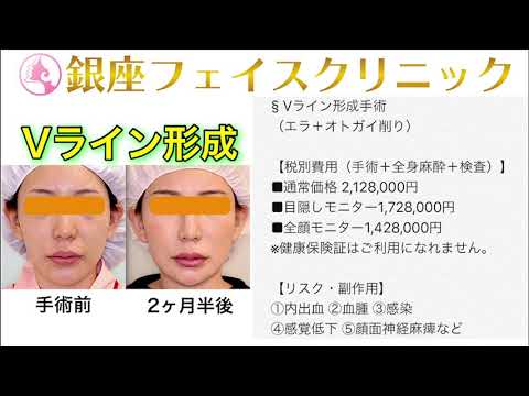 Vライン形成手術の症例写真 No.024