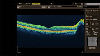 Canon Xephilio OCT A1 e HS100 - Analisi dei dati nozioni di base