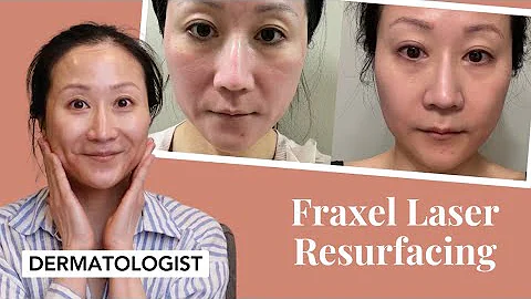 Dermatologist's experience with Dual Faxel Laser | Dr. Jenny Liu