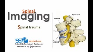 9- Imaging of Spinal trauma - Prof  Mamdouh Mahfouz