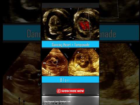 Dancing Heart in Fetal Pericardial Effusion: A Warning Sign of Cardiac Tamponade