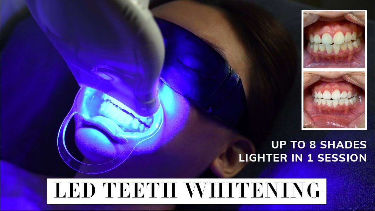 LED Teeth Whitening Up to 8 Shades Lighter in 1 Session Before and