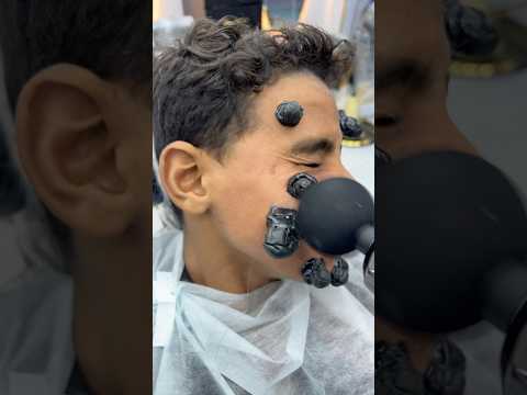 ازالة الحباية المتسلطنة من الخد