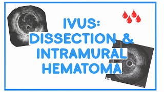 IVUS: Identificar DISSECÇÃO e HEMATOMA intramural