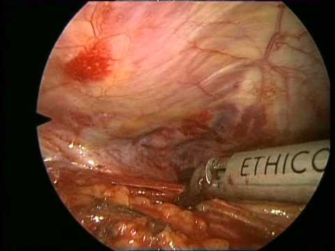 Video: Thymectomy Pada Myasthenia Gravis Nonthymomatous - Tinjauan Sistematis Dan Meta-analisis
