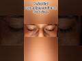 DARK CIRCLE (आँखों का कालापन) #pigmentation #hyperpigmentation #darkcircles #shortsfeed #shorts