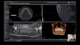 OnDemand3D CBCT SOFTWARE -  QUICKSTART how to video -