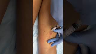 Склеротерапия — процедура по удалению сеточек. Запись по ссылке https://taplink.cc/dr_meline