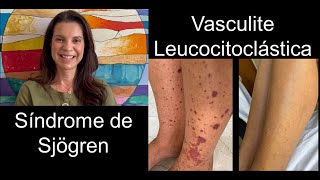 Alessandra - Vasculite Leucocitoclástica e Síndrome de Sjögren