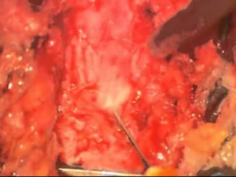 my accident 007.wmv