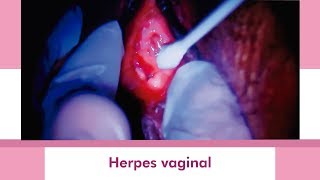 Herpes Vaginal / Vaginal Herpes
