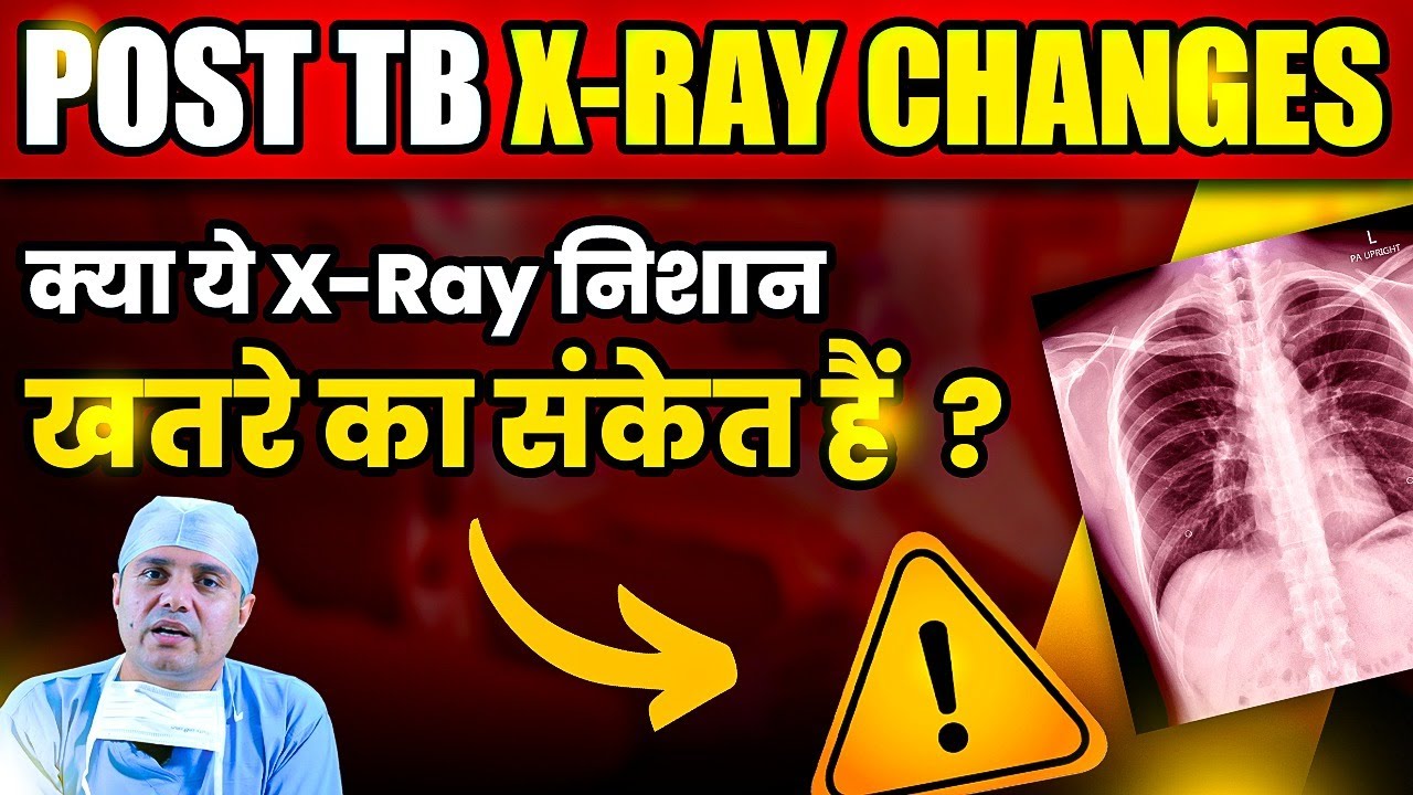 TB के बाद X-Ray में दिखने वाले निशान: कितने गंभीर हैं ये बदलाव? Post TB X-Ray Findings Dr Sukhram