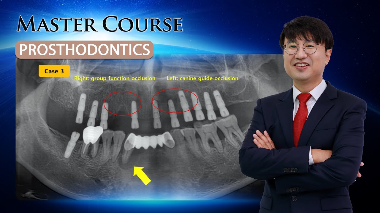 [Master Course - PROSTHODONTICS] Occlusion for implant-supported fixed ...